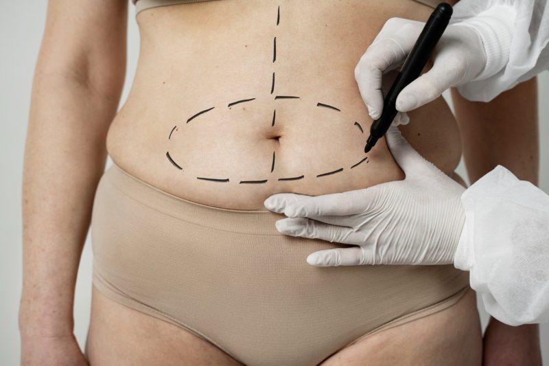 Body Contouring Treatments